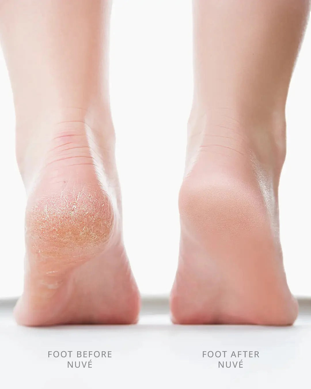 Rechargeable Callus Remover for Feet | Foot Scrubber for Dead Skin
