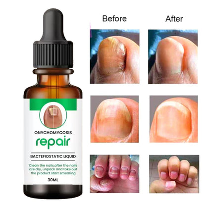Professional Nail Repair Serum - 100% Natural, Anti-Infective, Fungal Infection Removal, 30ML