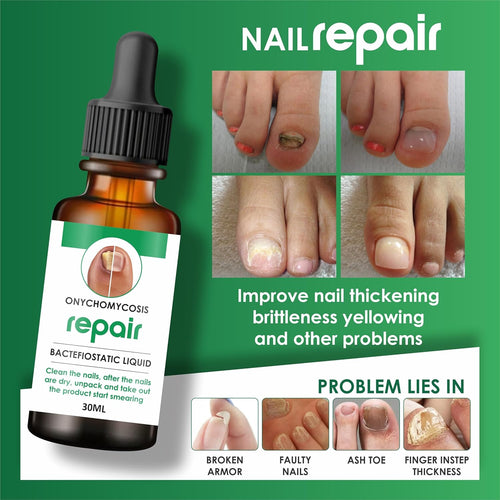 Professional Nail Repair Serum - 100% Natural, Anti-Infective, Fungal Infection Removal, 30ML