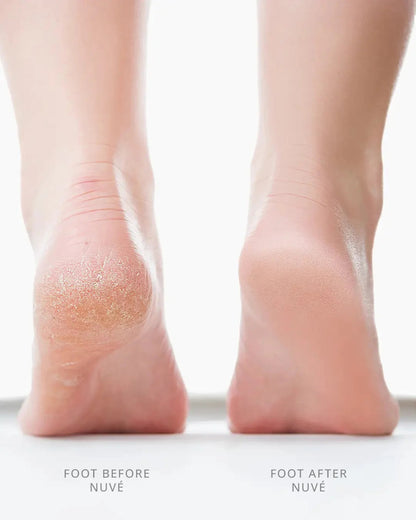 Rechargeable Callus Remover for Feet | Foot Scrubber for Dead Skin